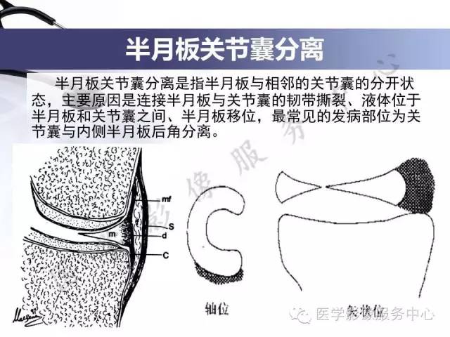 【PPT】半月板病变的MRI诊断