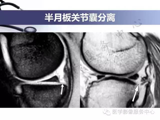 【PPT】半月板病变的MRI诊断