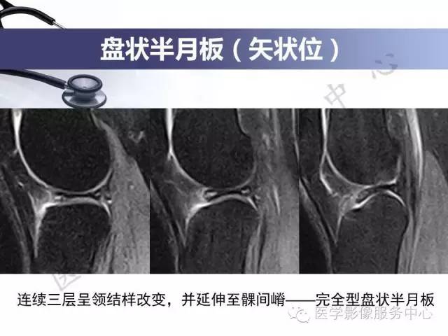 【PPT】半月板病变的MRI诊断