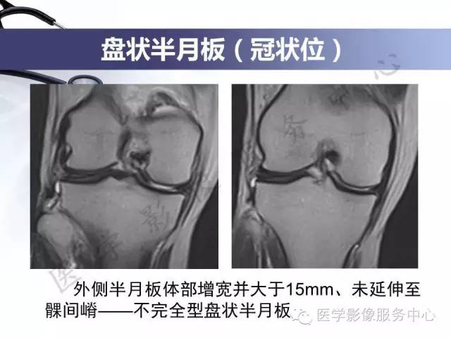 【PPT】半月板病变的MRI诊断