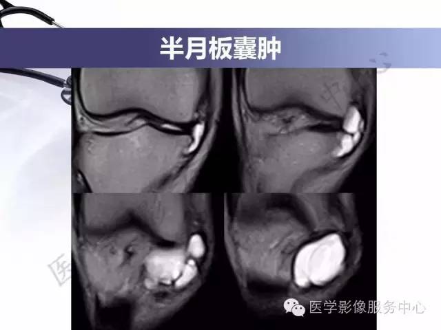 【PPT】半月板病变的MRI诊断