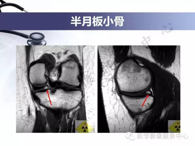 【PPT】半月板病变的MRI诊断
