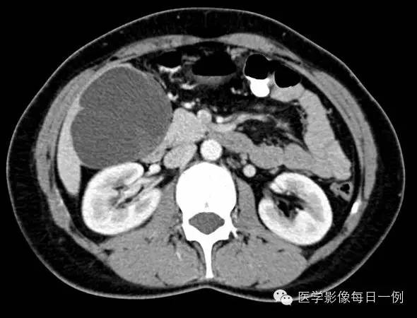 【病例】肝内胆管囊腺瘤1例CT病例分析 【病例】肝内胆管囊腺瘤1例CT病例分析