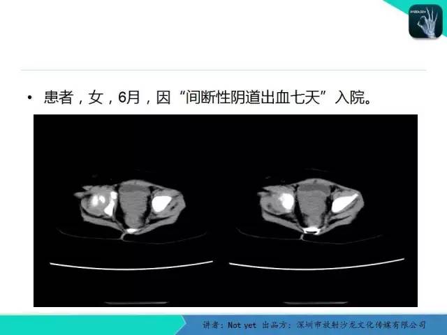 【病例】卵黄囊瘤一例CT影像表现