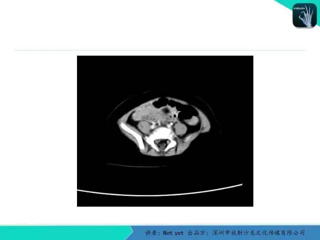 【病例】卵黄囊瘤一例CT影像表现