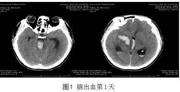 【病例】脑出血后脑死亡1例CT影像学分析 【病例】脑出血后脑死亡1例CT影像学分析
