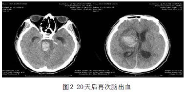 【病例】脑出血后脑死亡1例CT影像学分析 【病例】脑出血后脑死亡1例CT影像学分析