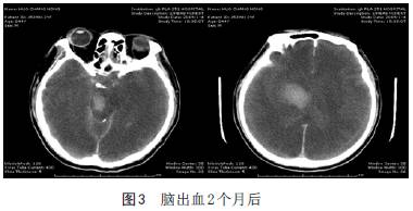 【病例】脑出血后脑死亡1例CT影像学分析