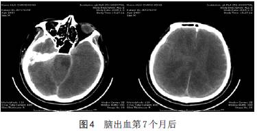【病例】脑出血后脑死亡1例CT影像学分析 【病例】脑出血后脑死亡1例CT影像学分析
