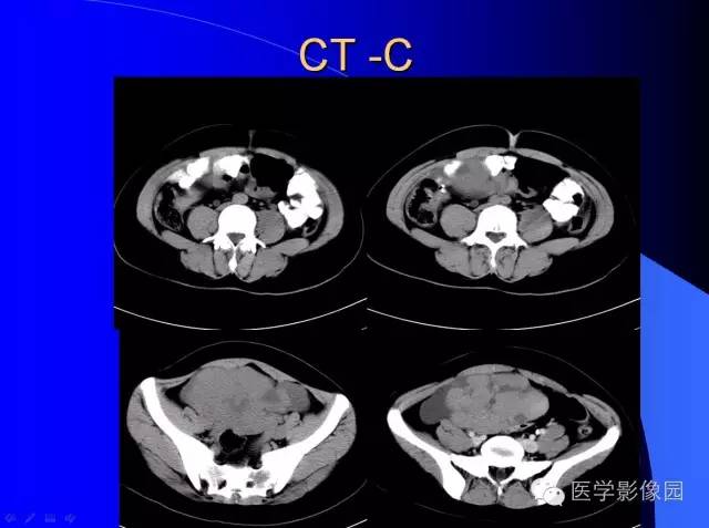 【病例】盆腔无性细胞瘤1例CT影像表现 【病例】盆腔无性细胞瘤1例CT影像表现