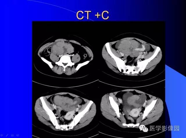 【病例】盆腔无性细胞瘤1例CT影像表现 【病例】盆腔无性细胞瘤1例CT影像表现