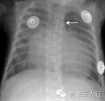 "挂蛋征"，这个征象提示啥？
