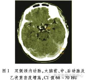 【病例】继发性红细胞增多症CT表现1例