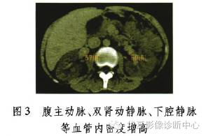 【病例】继发性红细胞增多症CT表现1例 【病例】继发性红细胞增多症CT表现1例