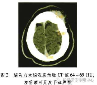 【病例】继发性红细胞增多症CT表现1例 【病例】继发性红细胞增多症CT表现1例