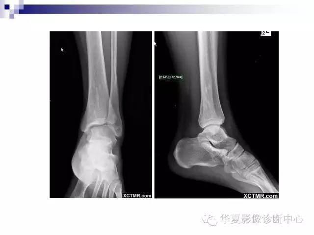 【PPT】骨斑点症
