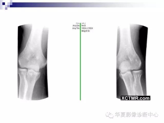 【PPT】骨斑点症