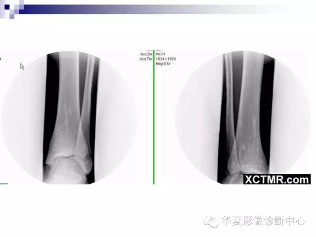 【PPT】骨斑点症