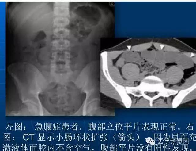 【PPT】急腹症X线、CT诊断与鉴别诊断