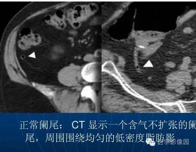 【PPT】急腹症X线、CT诊断与鉴别诊断