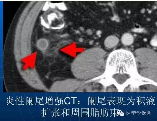 【PPT】急腹症X线、CT诊断与鉴别诊断