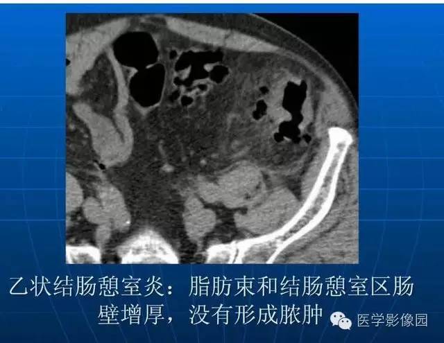 【PPT】急腹症X线、CT诊断与鉴别诊断