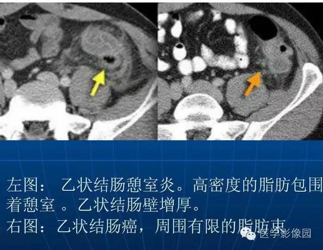 【PPT】急腹症X线、CT诊断与鉴别诊断