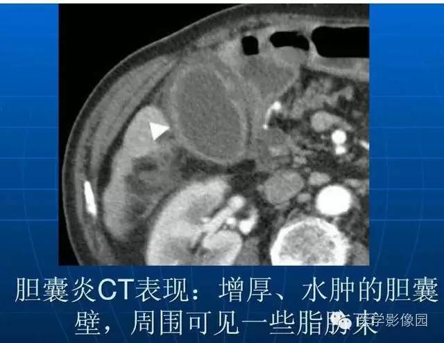 【PPT】急腹症X线、CT诊断与鉴别诊断