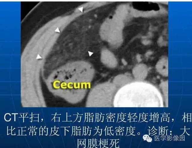【PPT】急腹症X线、CT诊断与鉴别诊断