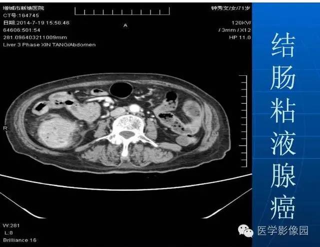 【PPT】急腹症X线、CT诊断与鉴别诊断