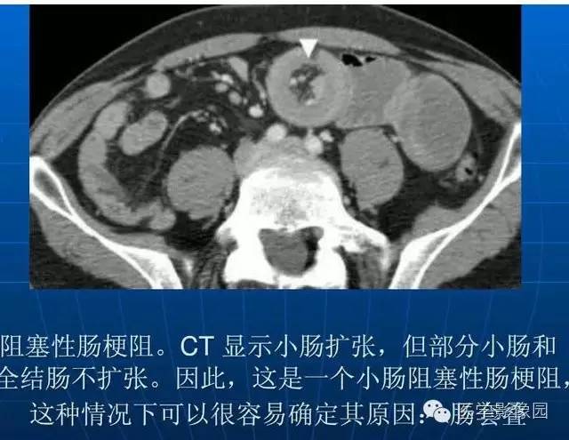 【PPT】急腹症X线、CT诊断与鉴别诊断