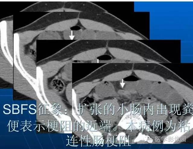【PPT】急腹症X线、CT诊断与鉴别诊断