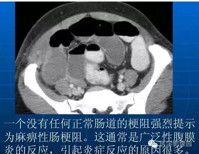 【PPT】急腹症X线、CT诊断与鉴别诊断