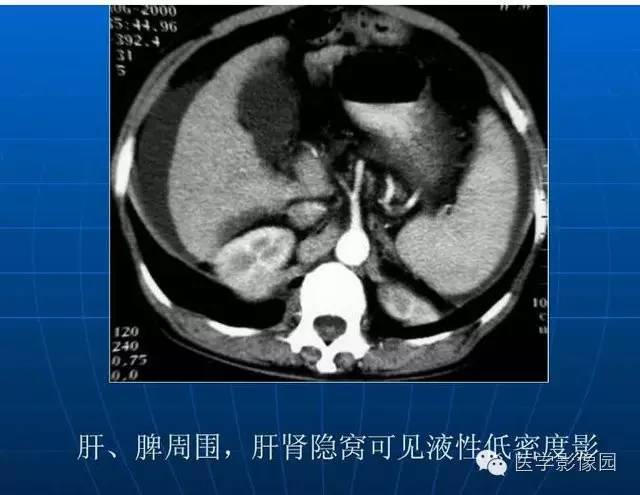 【PPT】急腹症X线、CT诊断与鉴别诊断