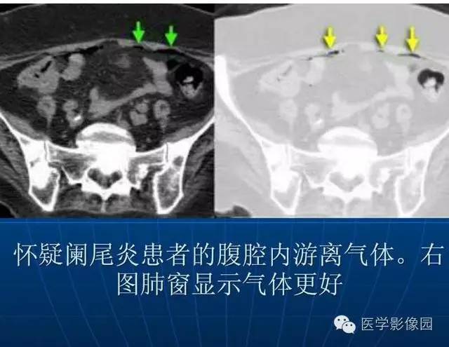 【PPT】急腹症X线、CT诊断与鉴别诊断