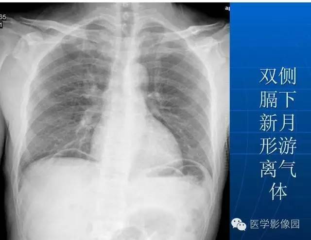 【PPT】急腹症X线、CT诊断与鉴别诊断