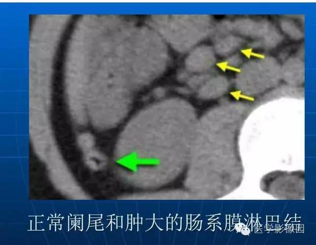 【PPT】急腹症X线、CT诊断与鉴别诊断