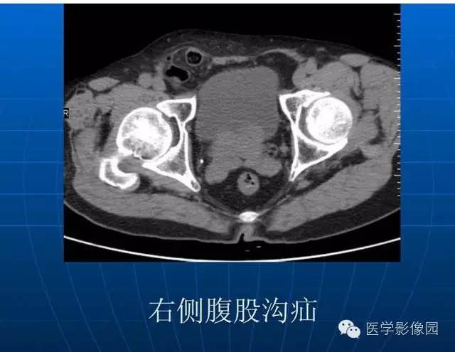 【PPT】急腹症X线、CT诊断与鉴别诊断