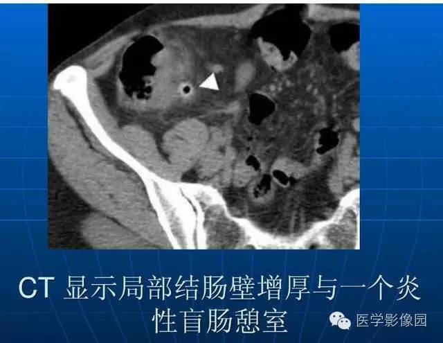【PPT】急腹症X线、CT诊断与鉴别诊断