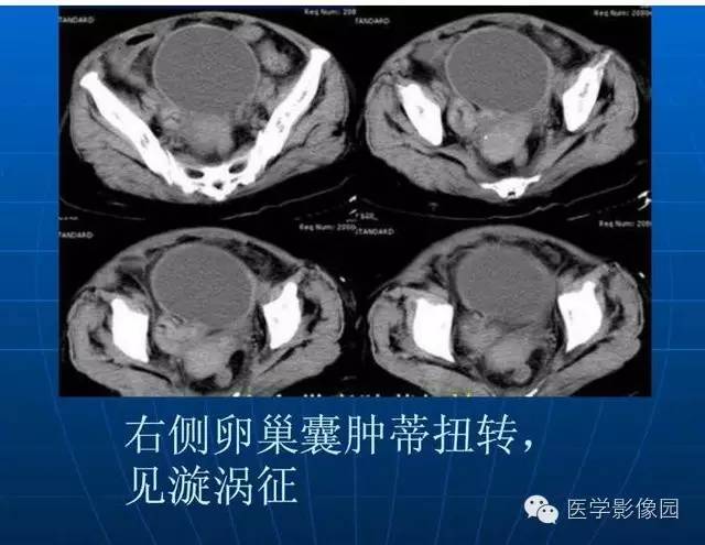 【PPT】急腹症X线、CT诊断与鉴别诊断