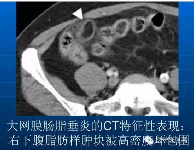【PPT】急腹症X线、CT诊断与鉴别诊断
