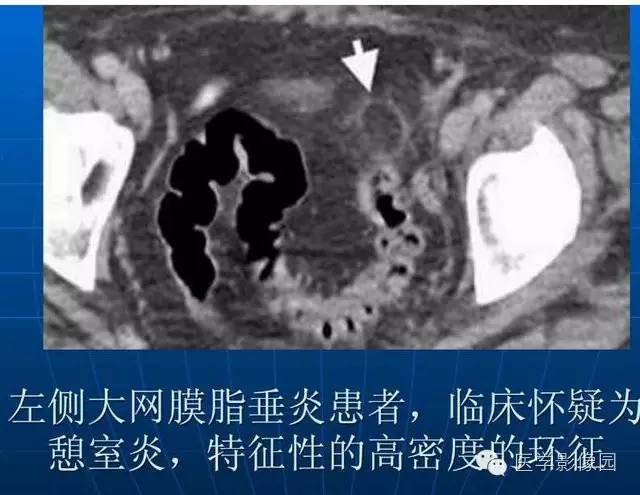 【PPT】急腹症X线、CT诊断与鉴别诊断