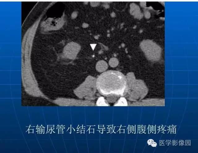 【PPT】急腹症X线、CT诊断与鉴别诊断