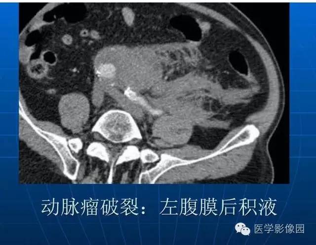 【PPT】急腹症X线、CT诊断与鉴别诊断