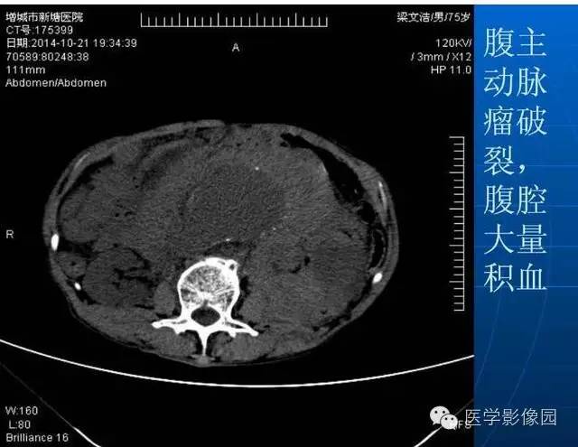 【PPT】急腹症X线、CT诊断与鉴别诊断