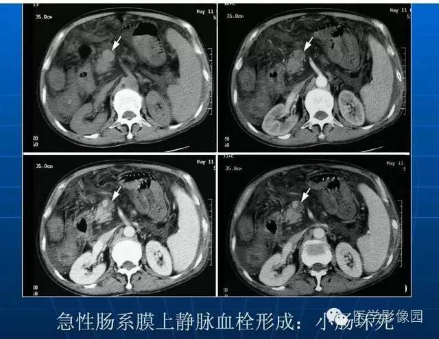 【PPT】急腹症X线、CT诊断与鉴别诊断