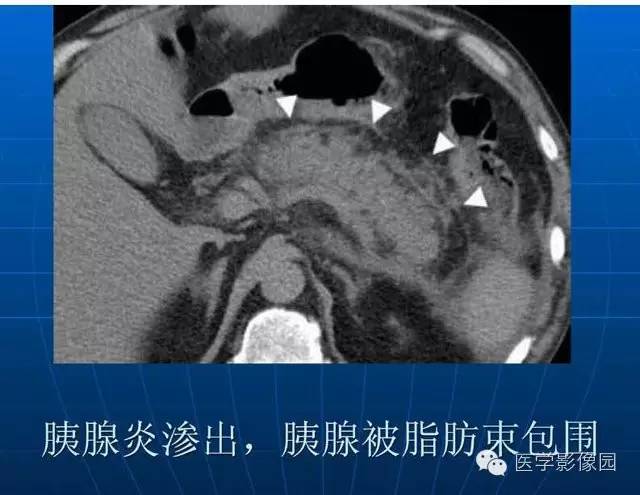 【PPT】急腹症X线、CT诊断与鉴别诊断