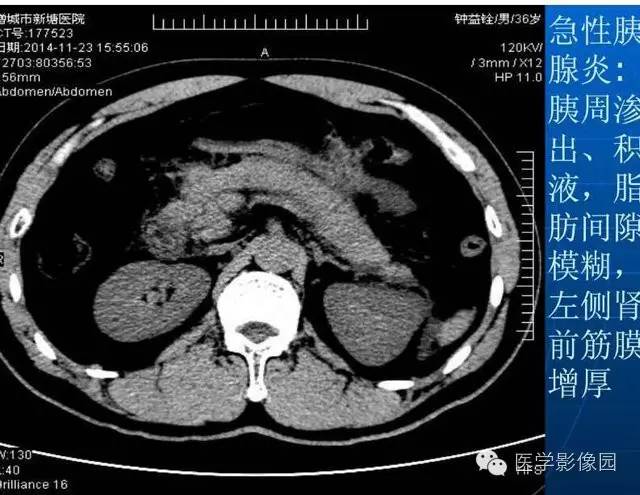 【PPT】急腹症X线、CT诊断与鉴别诊断