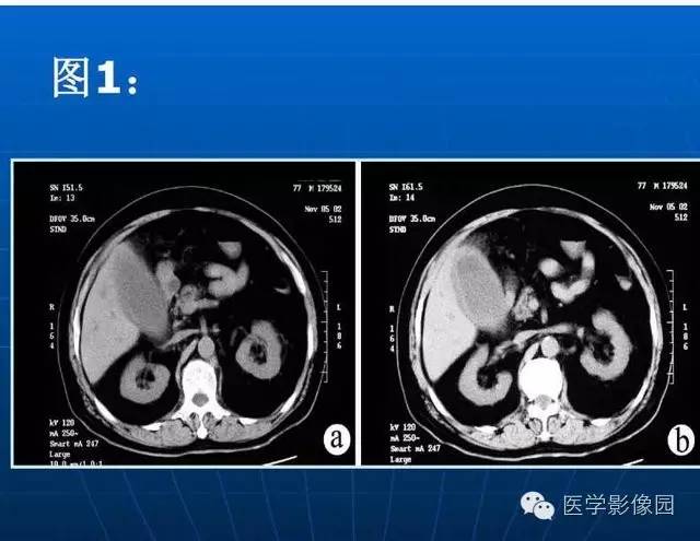 【PPT】急腹症X线、CT诊断与鉴别诊断