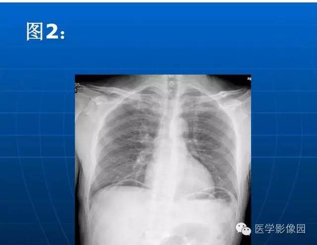 【PPT】急腹症X线、CT诊断与鉴别诊断